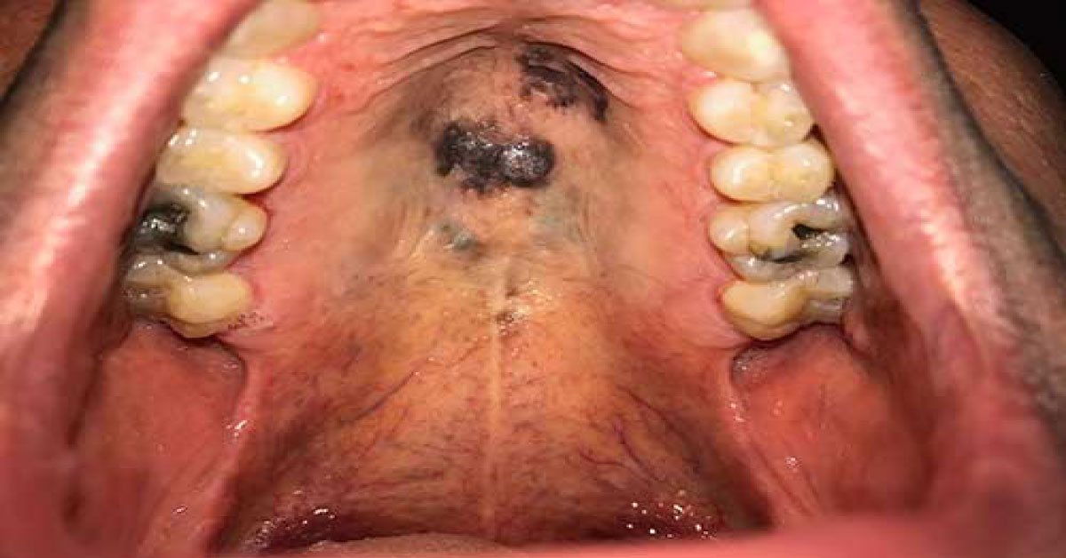 Identify This Condition With Black Palate