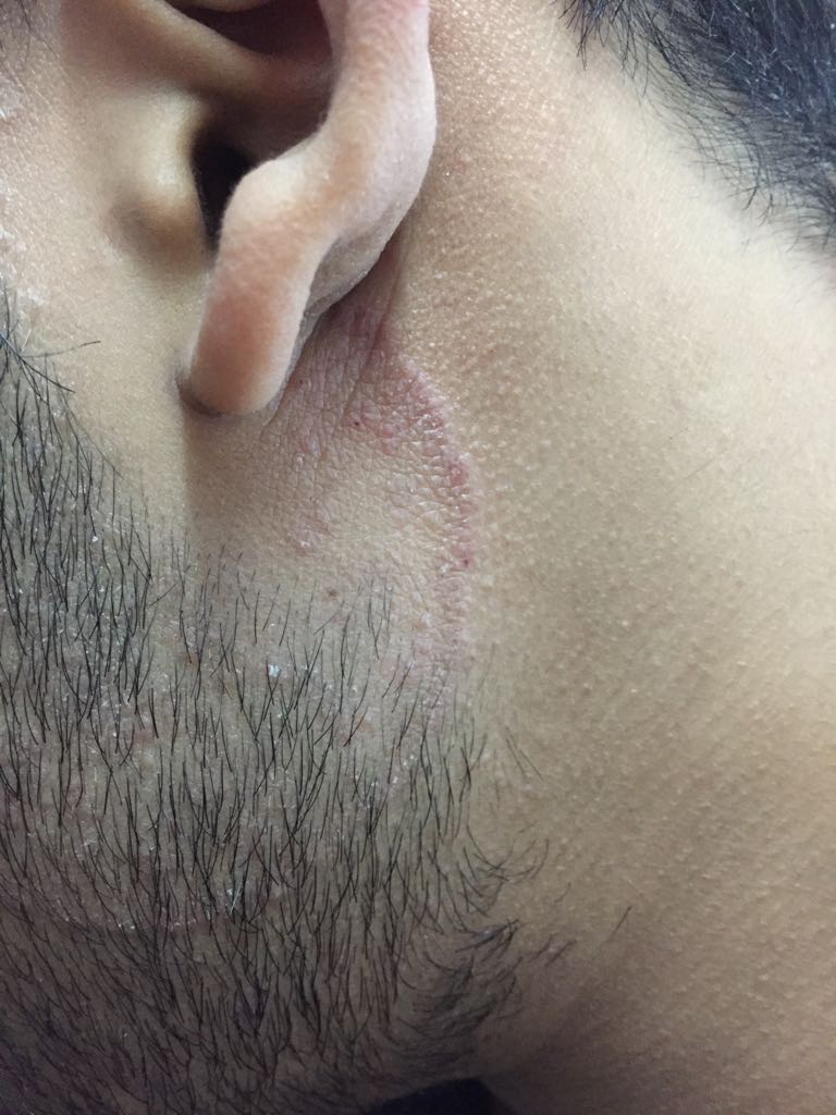 Identify This Skin Disease