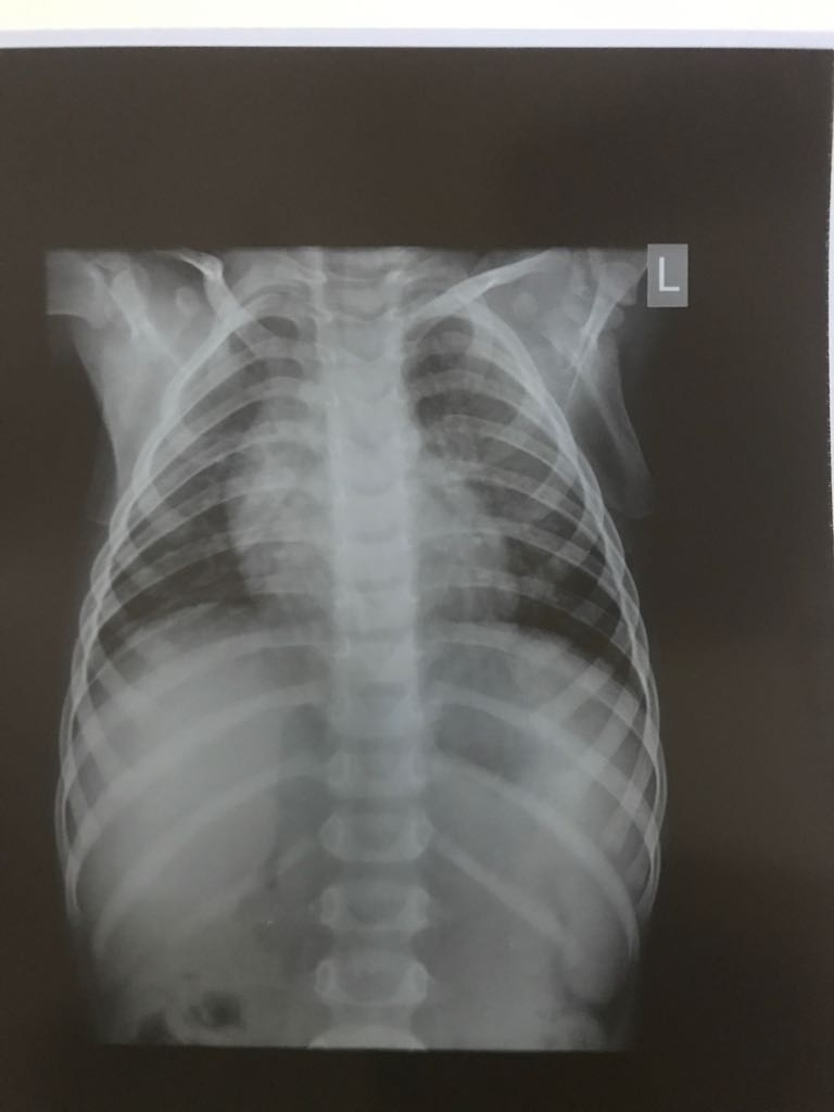 Urgently Suggestions Needed On This X-ray Chest