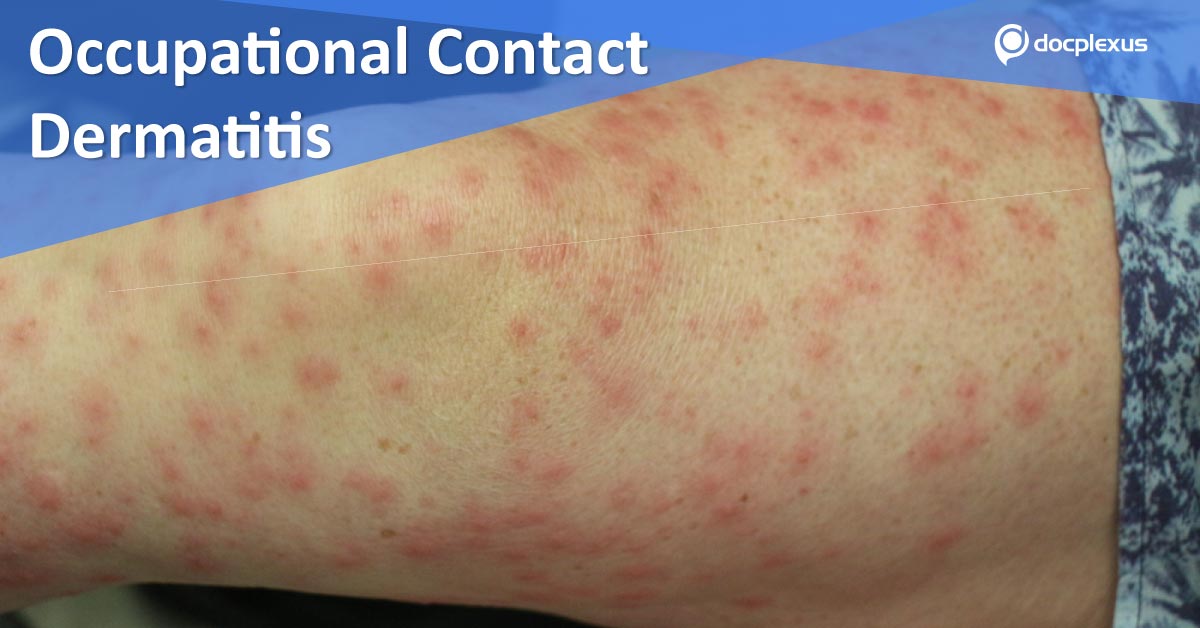 Occupational Contact dermatitis: Clinical Management Guidelines