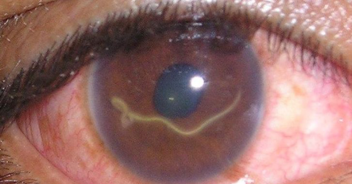 A Worm Wriggling Inside His Eyeball For 3 Weeks