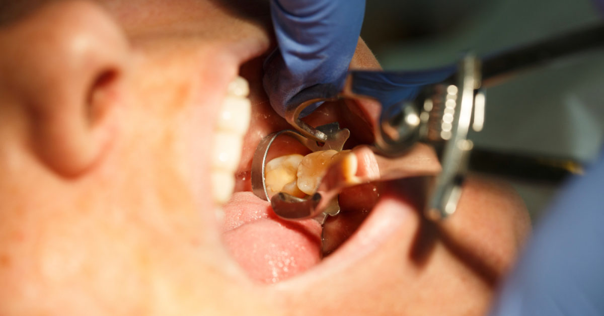 Estrogen Therapy Prevents Tooth And Gum Diseases In Post Menopause