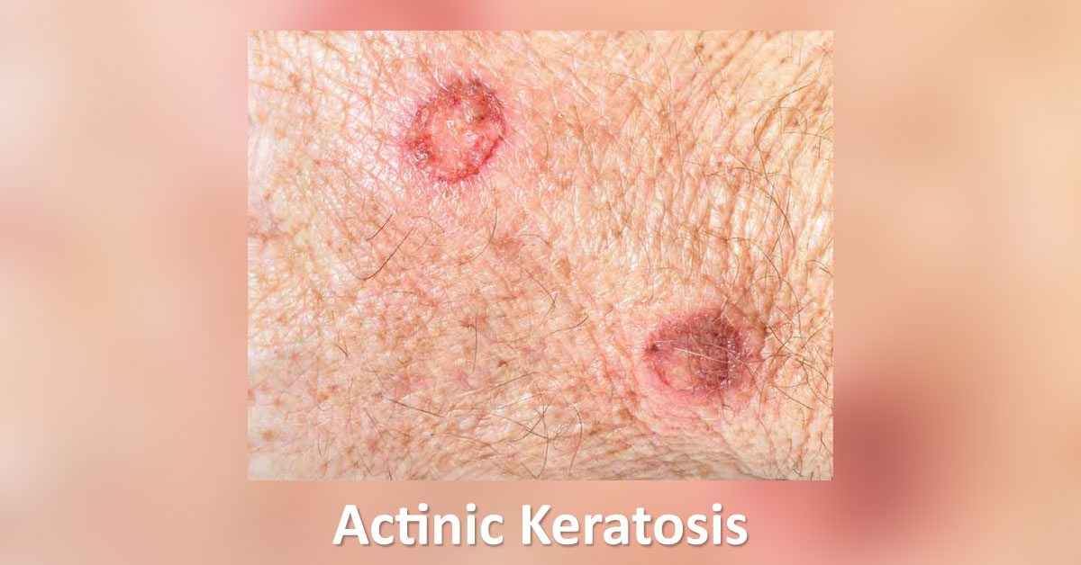 Actinic Keratosis, Clinical Practice Recommendations
