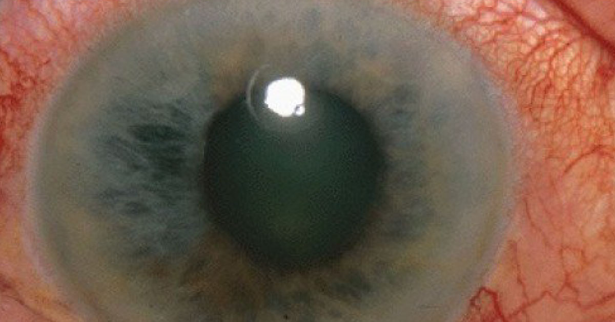 Clinical Choices For Reducing Elevated Intraocular Pressure