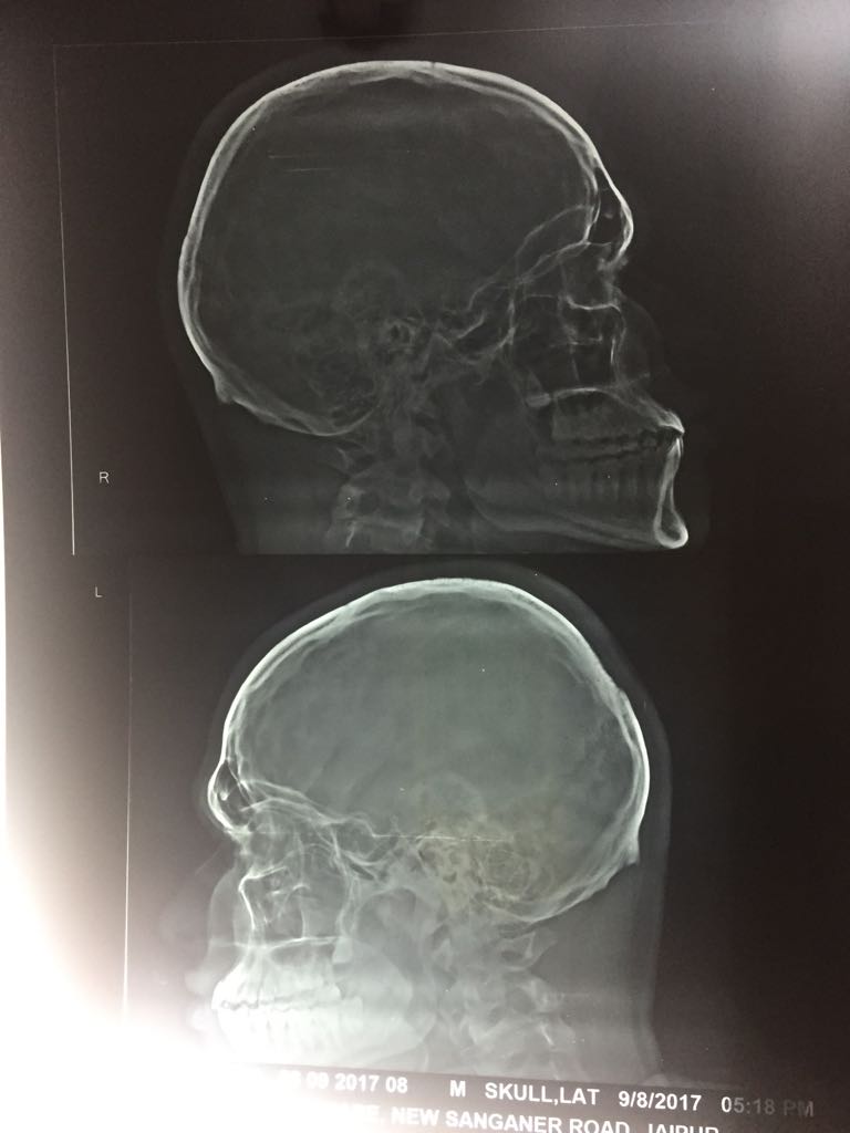 Is There Any Abnormality In X-ray Of Skull?