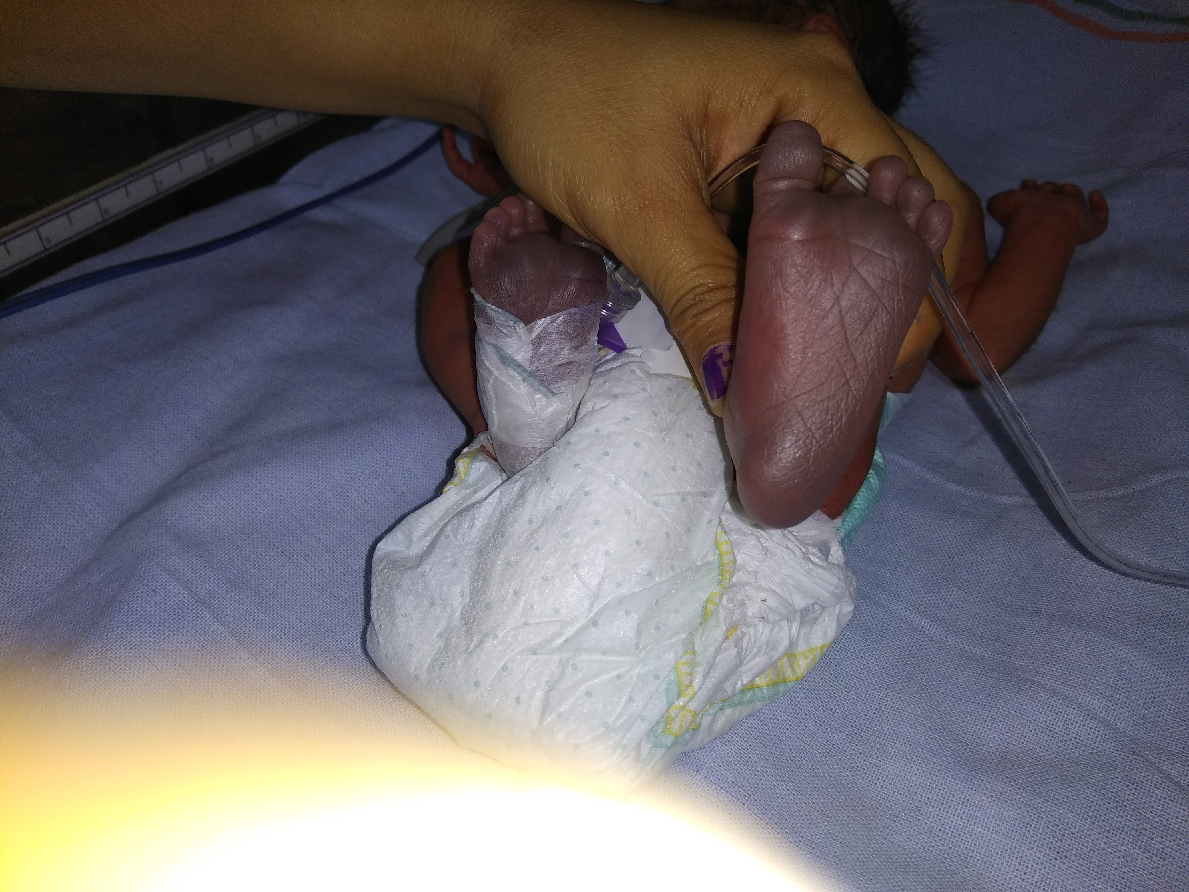 Preterm Breech New Born With Preipheral Cynosis