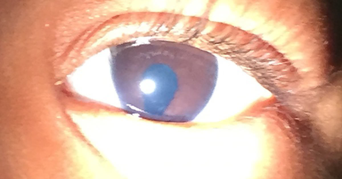 Baby With Oval Shaped Pupil