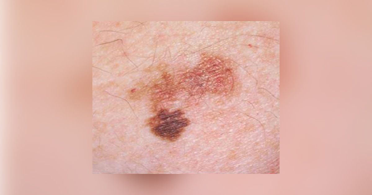 Primary Cutaneous Melanoma: Management Recommendations