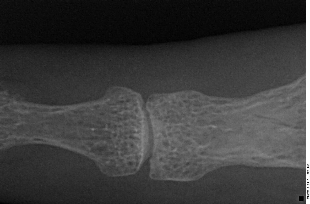 Can Fracture Occur Due To Smiley Spongy Ball