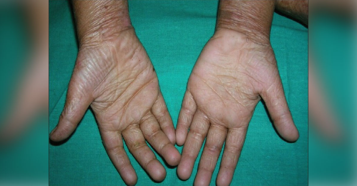 Palmar Skin, An Important Property Not Described Well