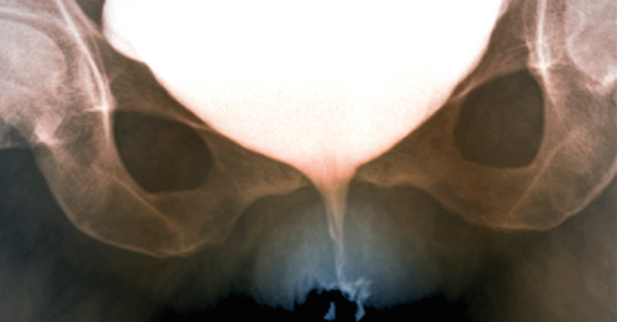 Identify This Urological Disorder
