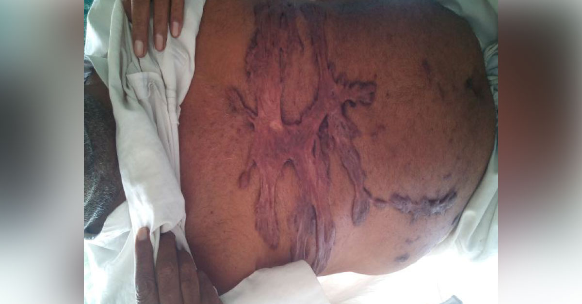 Keloid After Burn