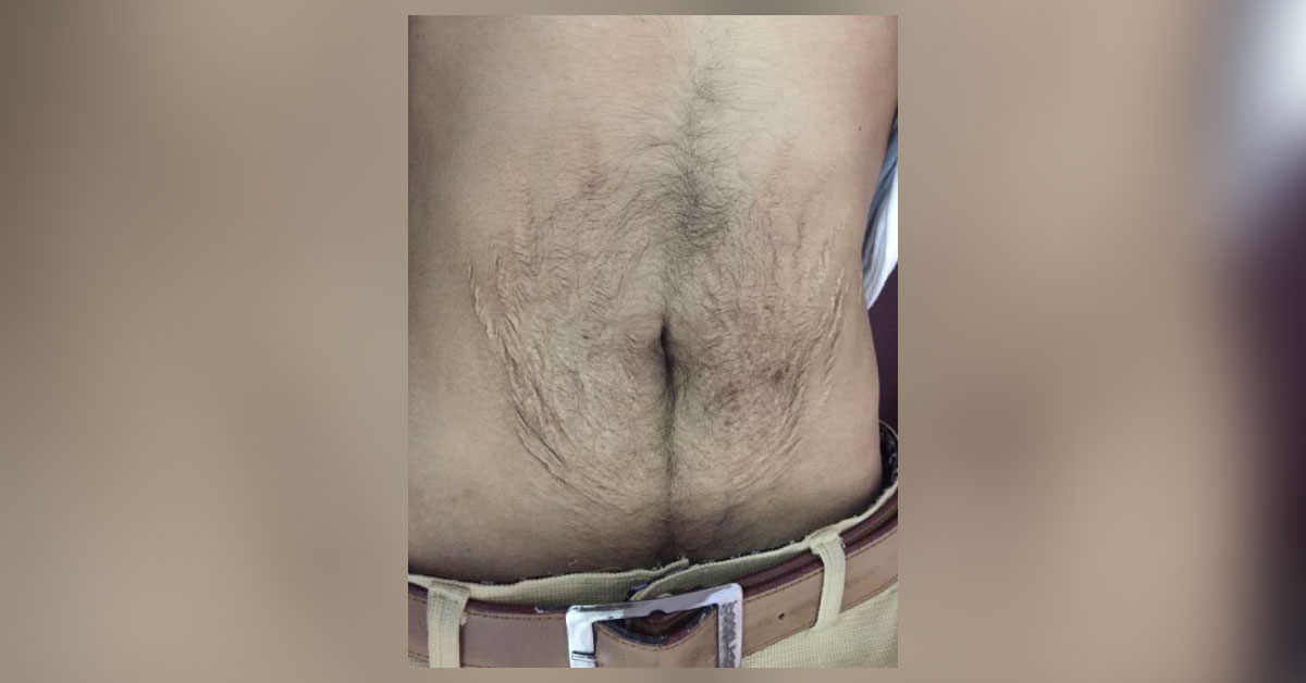 Identify Sex Of Patient By Abdominal Stria