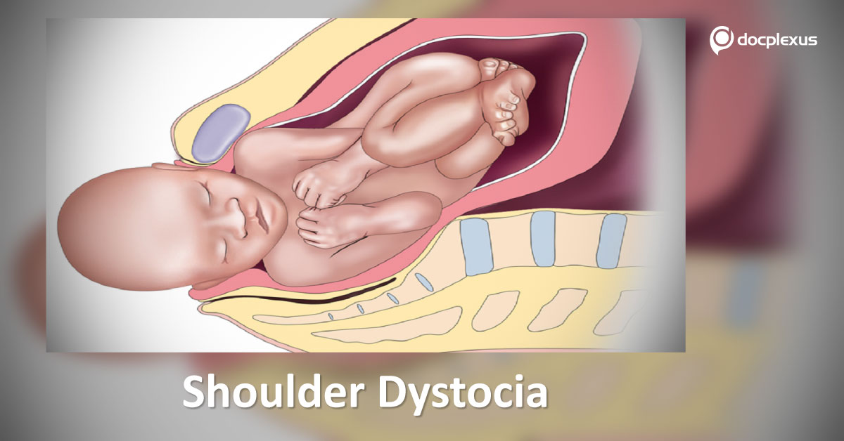Shoulder Dystocia: Risk Factors And Management