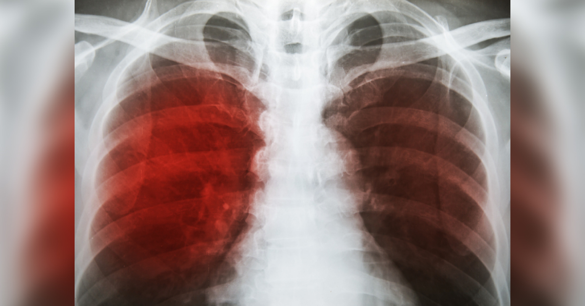 Low Levels Of Vitamin A May Increase The Risk Of TB