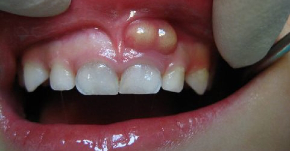 Spot This Dental Condition