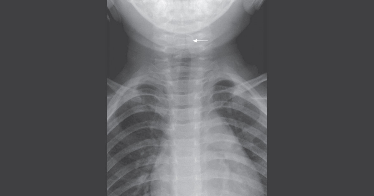 Identify This Condition In An Infant