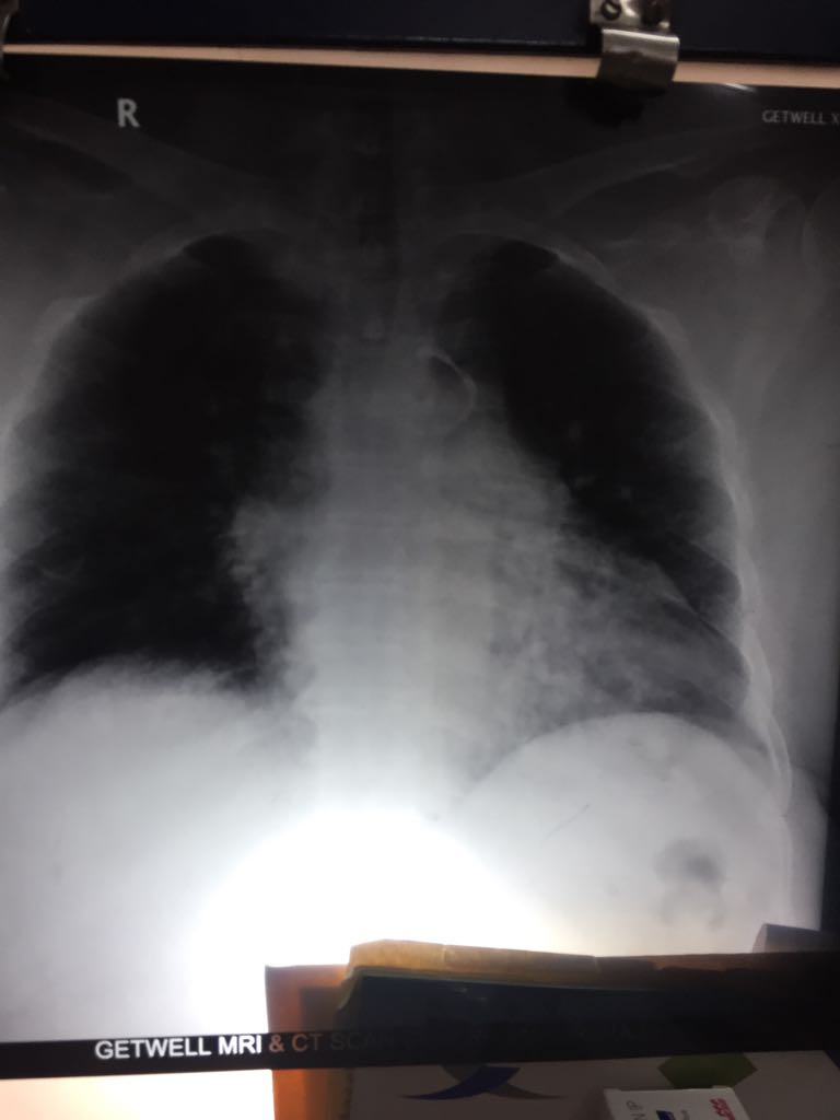 What Are These Nodular Shadows Around Heart? 