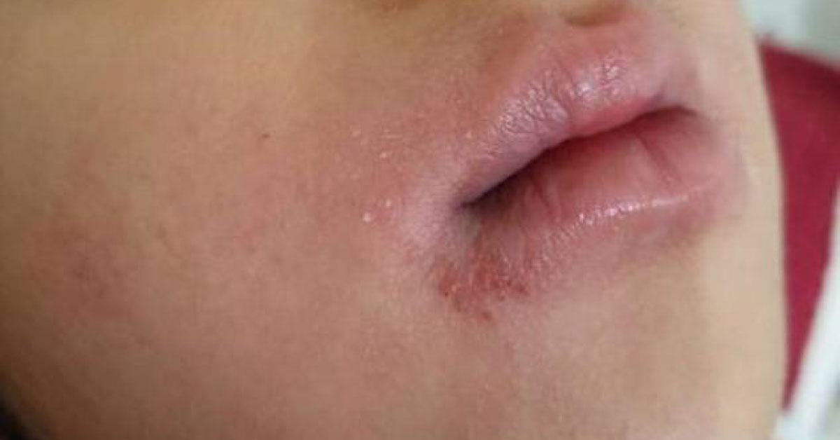 What Is This Skin Lesion?  
