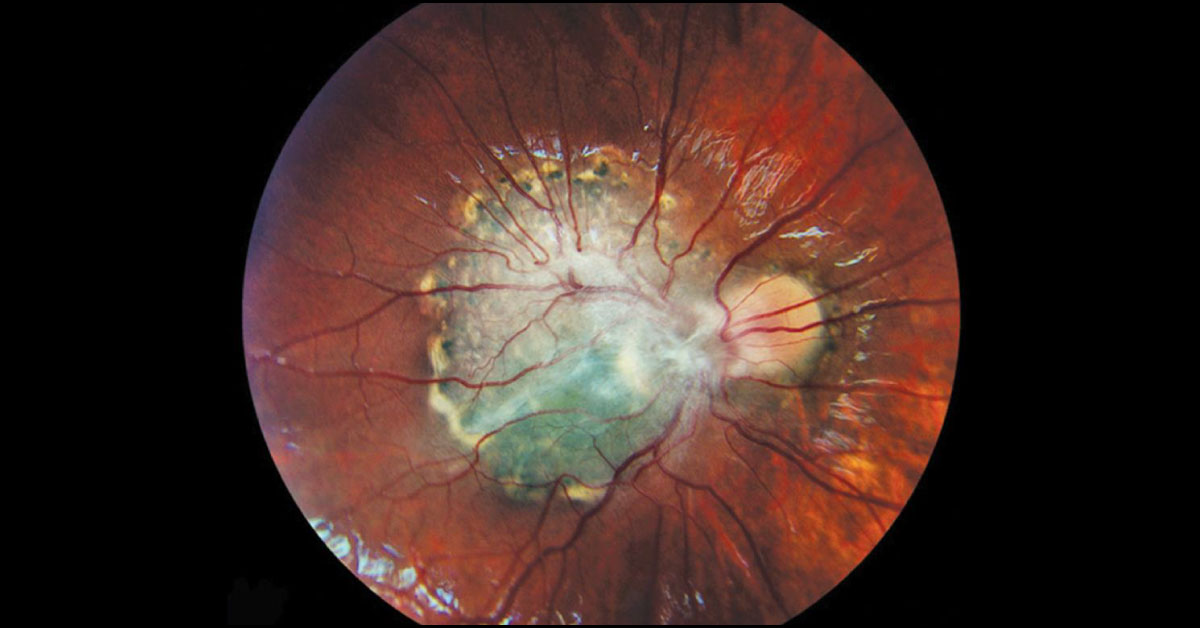 Ophthalmology Spot Diagnosis
