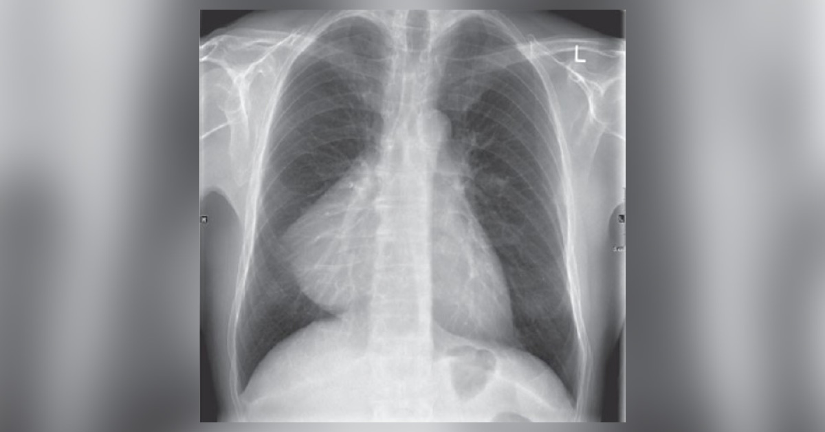 Heavy Smoker With Chest Pain
