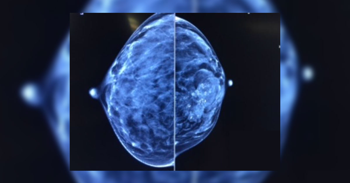 Breast Lump In A Multiparous Female