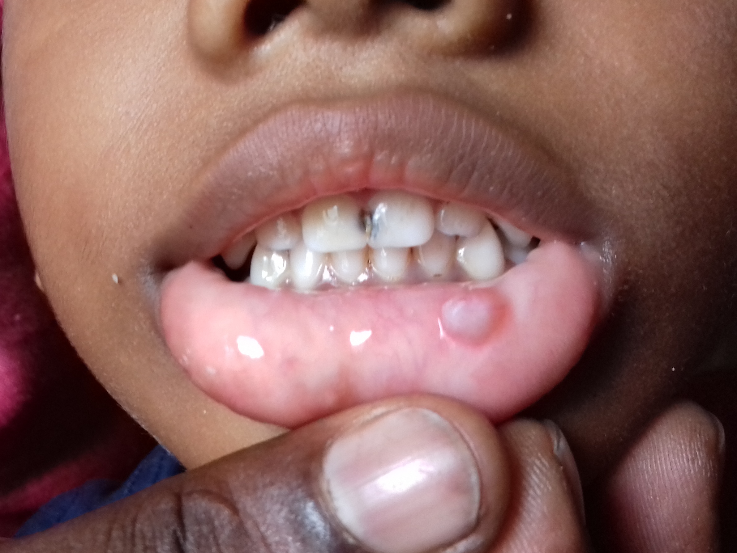 Swelling Lower Lips