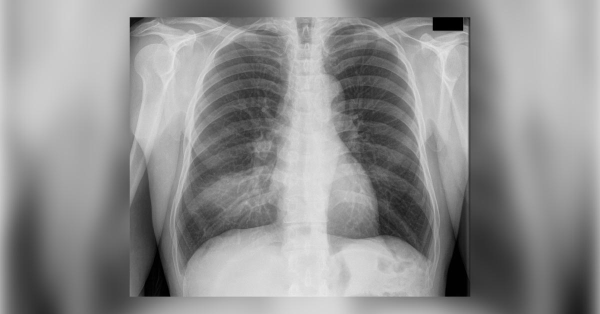 Hospital Acquired Pneumonia, Diagnostic Concerns And Treatment Considerations