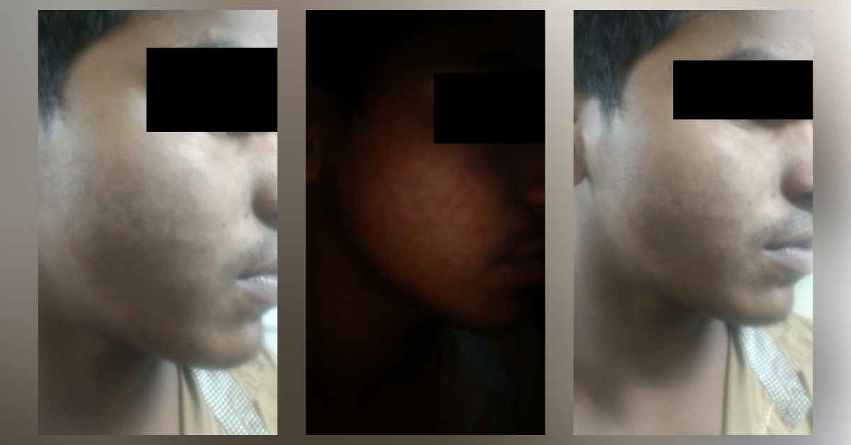 Skin Lesions Over Face