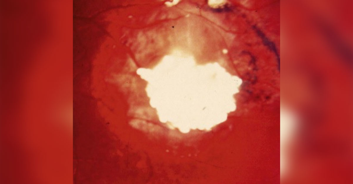 Diagnose The Eye Condition
