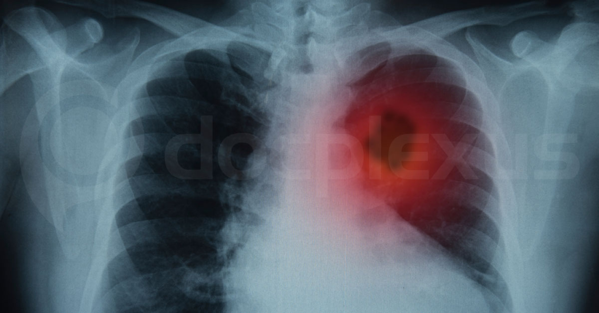 Metastatic non-small-cell lung cancer: ESMO Clinical Practice Guidelines for diagnosis, treatment and follow-up