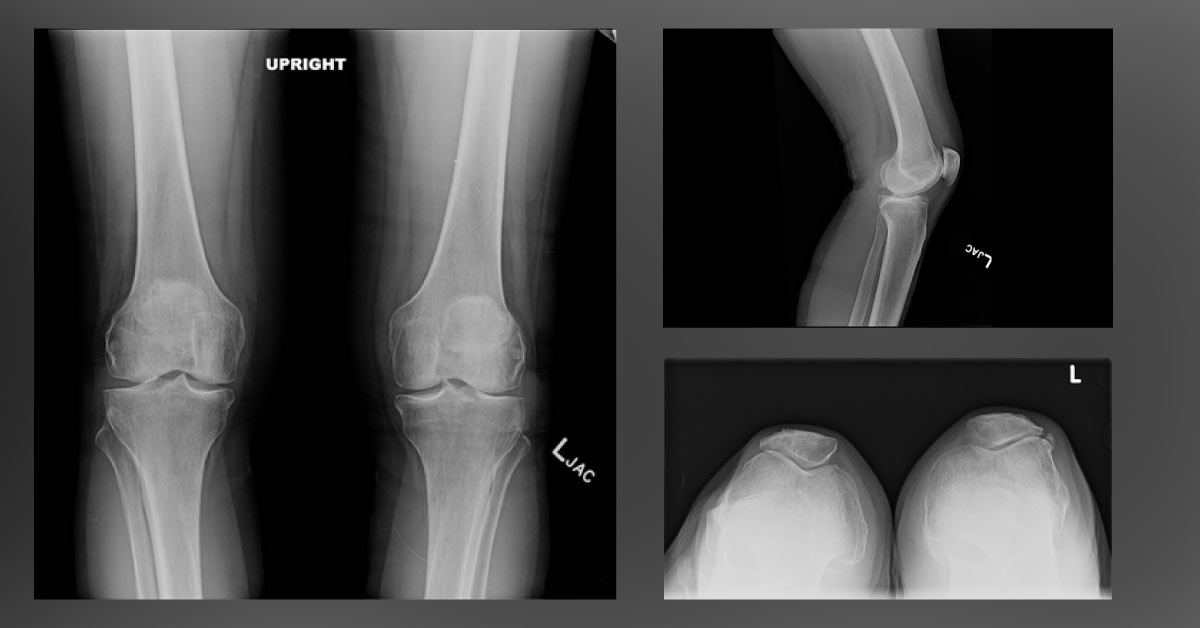 Which Grade Of Arthritis This Patient Has?