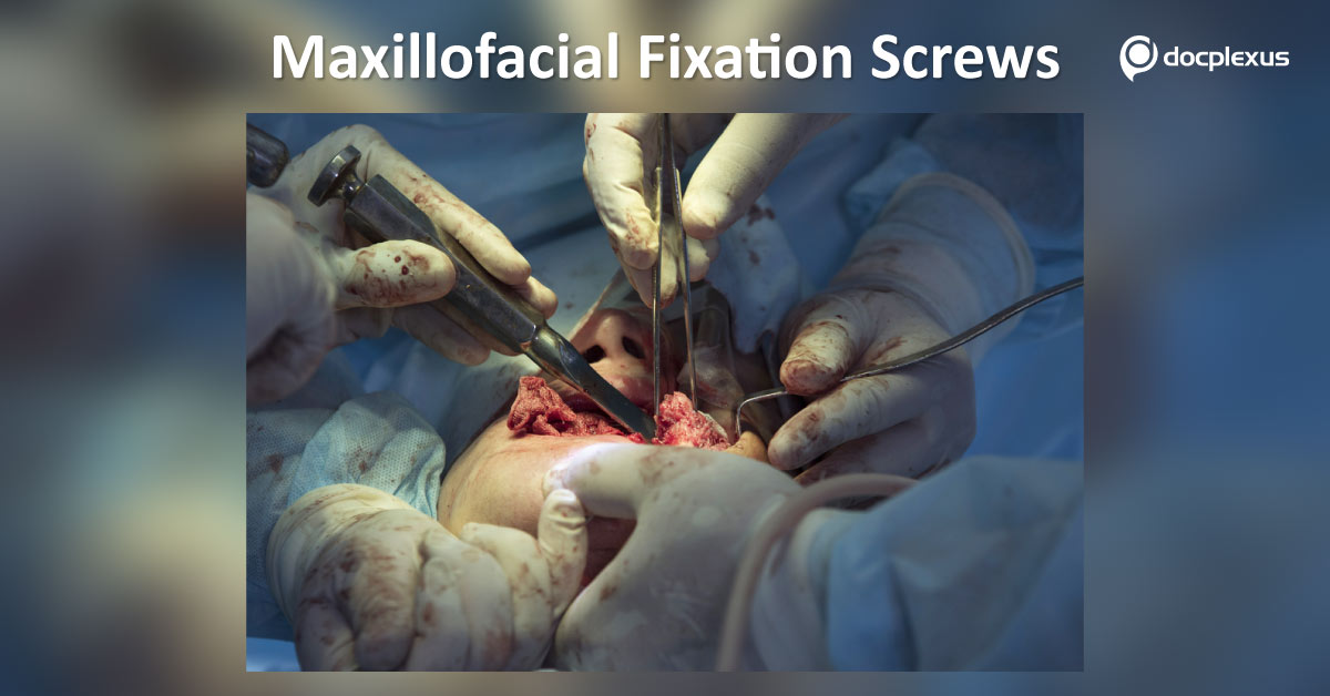 Overview Of Mandibulo Maxillary Fixation Screws