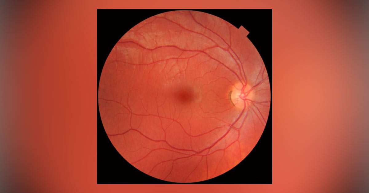 Risk Factors For Age Related Maculopathy