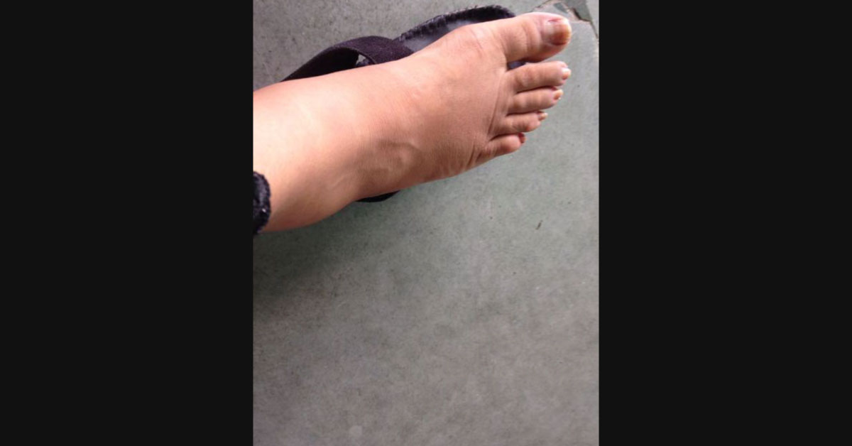 A Case Discussion Of B/L Pedal Oedema Post Viral Infection