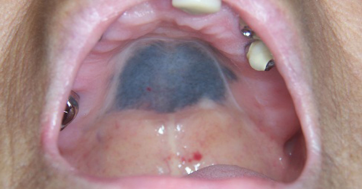 Blue Lesion Over Hard Palate