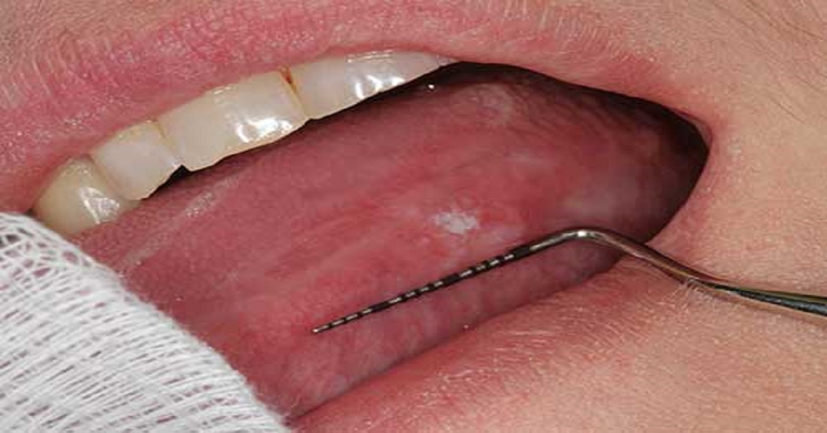 Is This A Case Of Squamous Cell Carcinoma