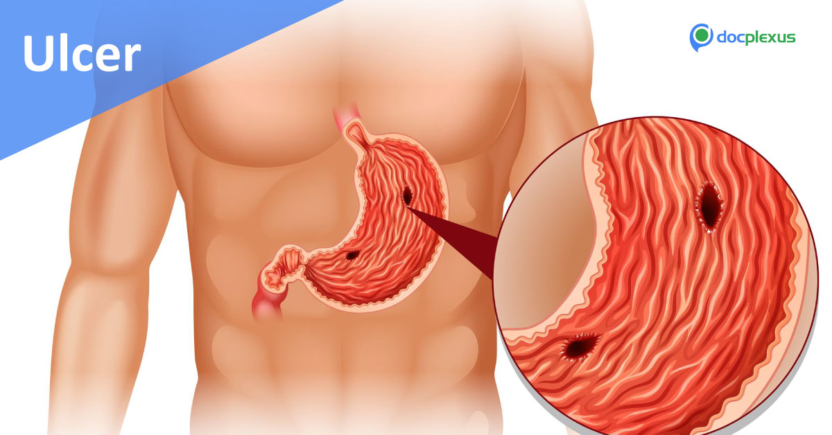 Peptic Ulcer, A Detailed Outline