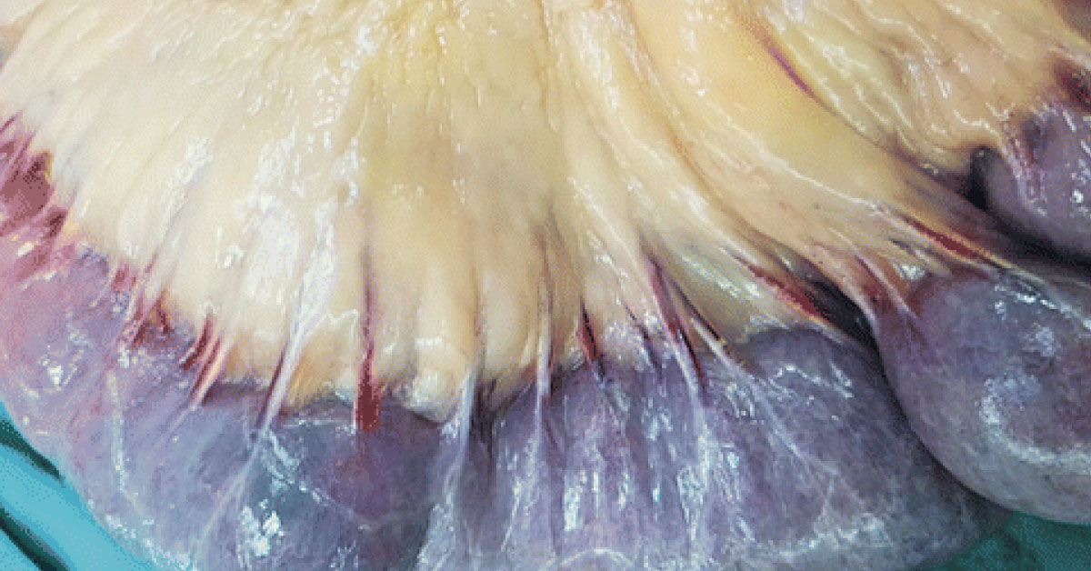 Identify This Condition In A Cirrhotic Patient