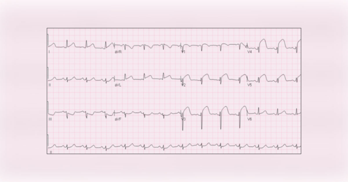 Interpret This ECG