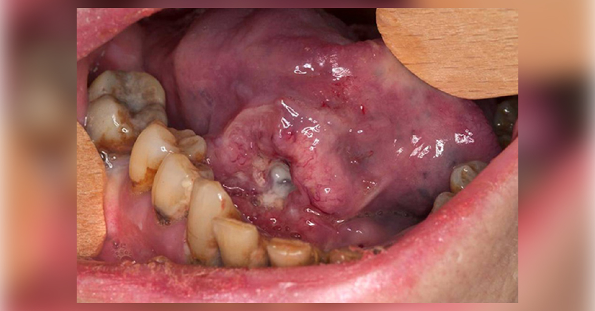 Spot This Oral Condition