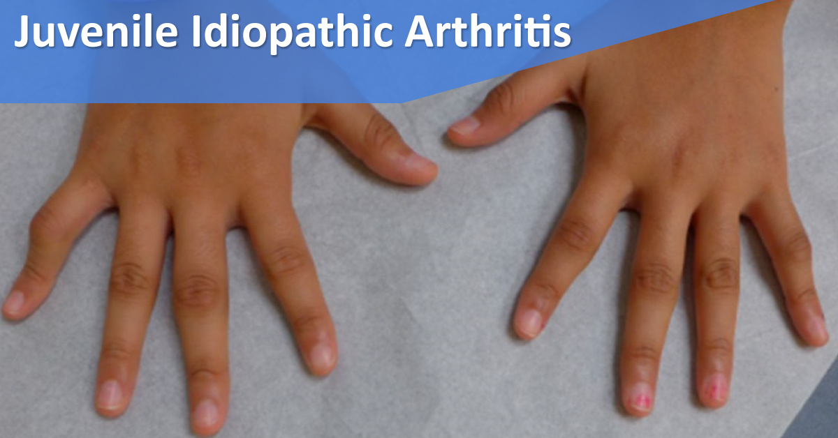 Evolving Techniques For Management Of Juvenile Idiopathic Arthritis