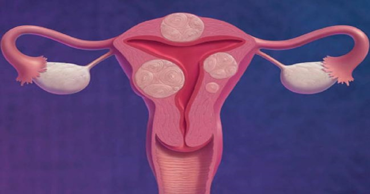 Pharmacological Treatment Of Uterine Fibroids