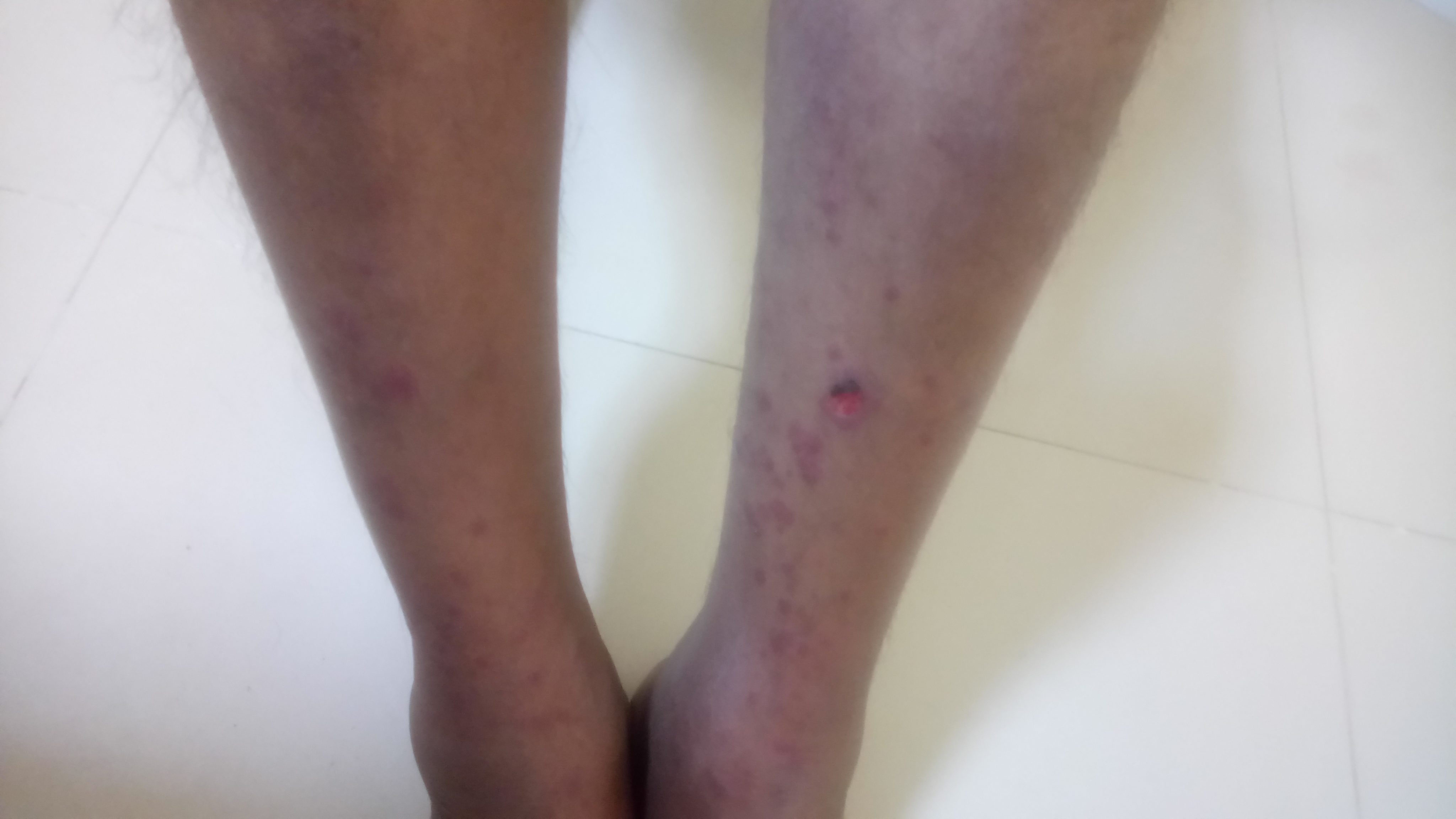 Management Of This Skin Condition