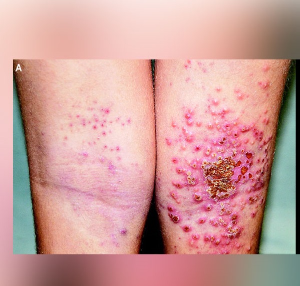 Identify The Type Of Infection