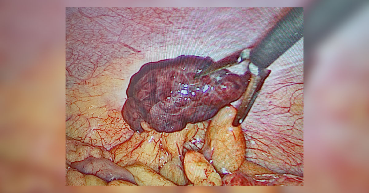Left Illiac Fossa Pain A Diagnostic Dilemma - May Be Appendagitis 