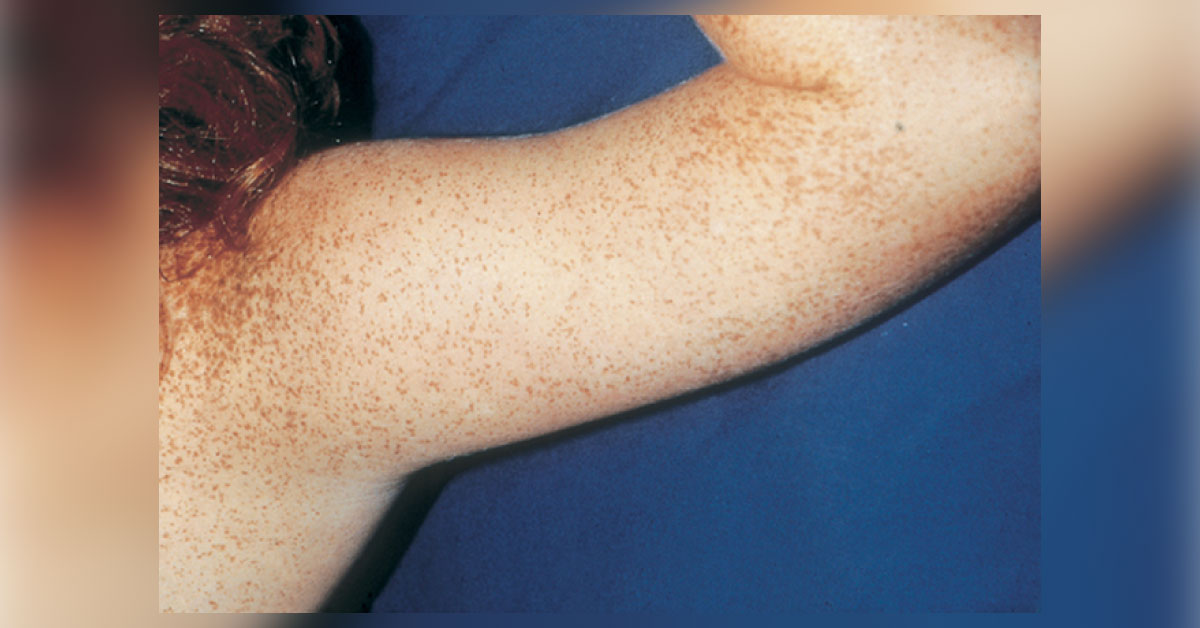 Identify This Dermatological Condition