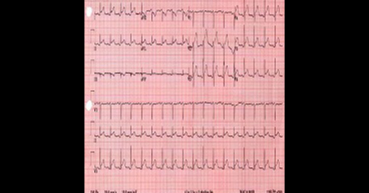 Evaluation Of A Diastolic Murmur