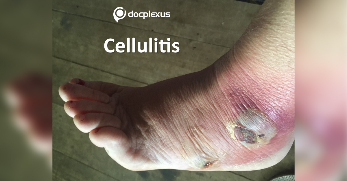 Cellulitis: Treatment and Management