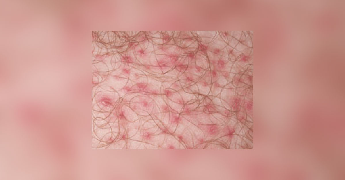 Identify The Dermatology Case